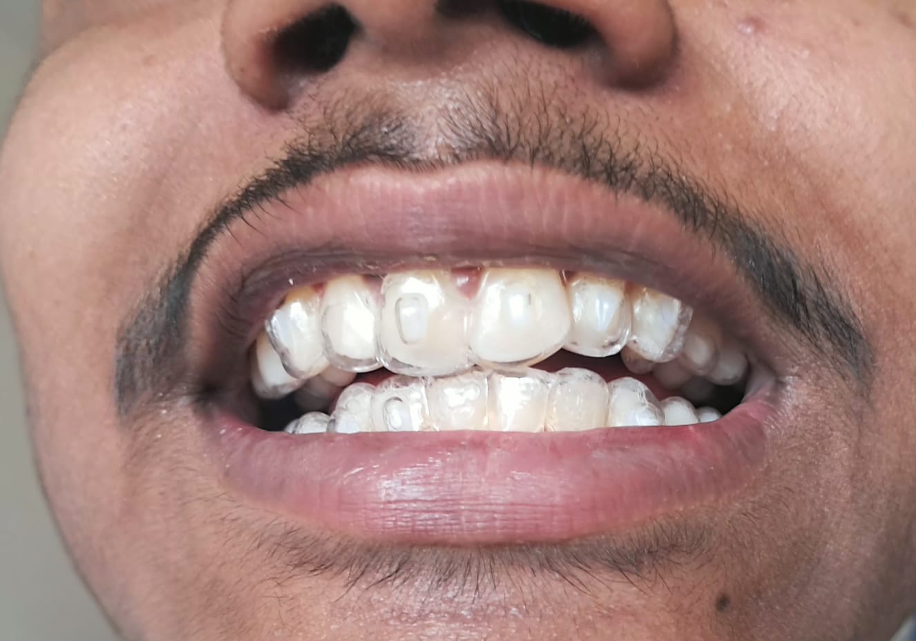 Clear Aligners photo 1