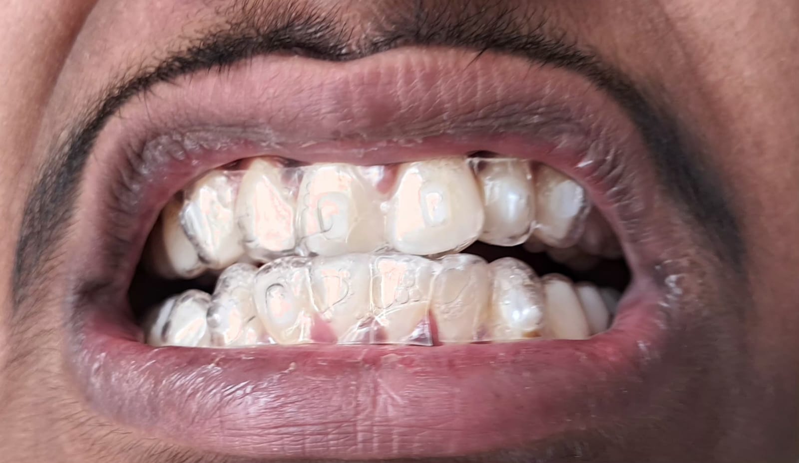 Clear Aligners photo 2