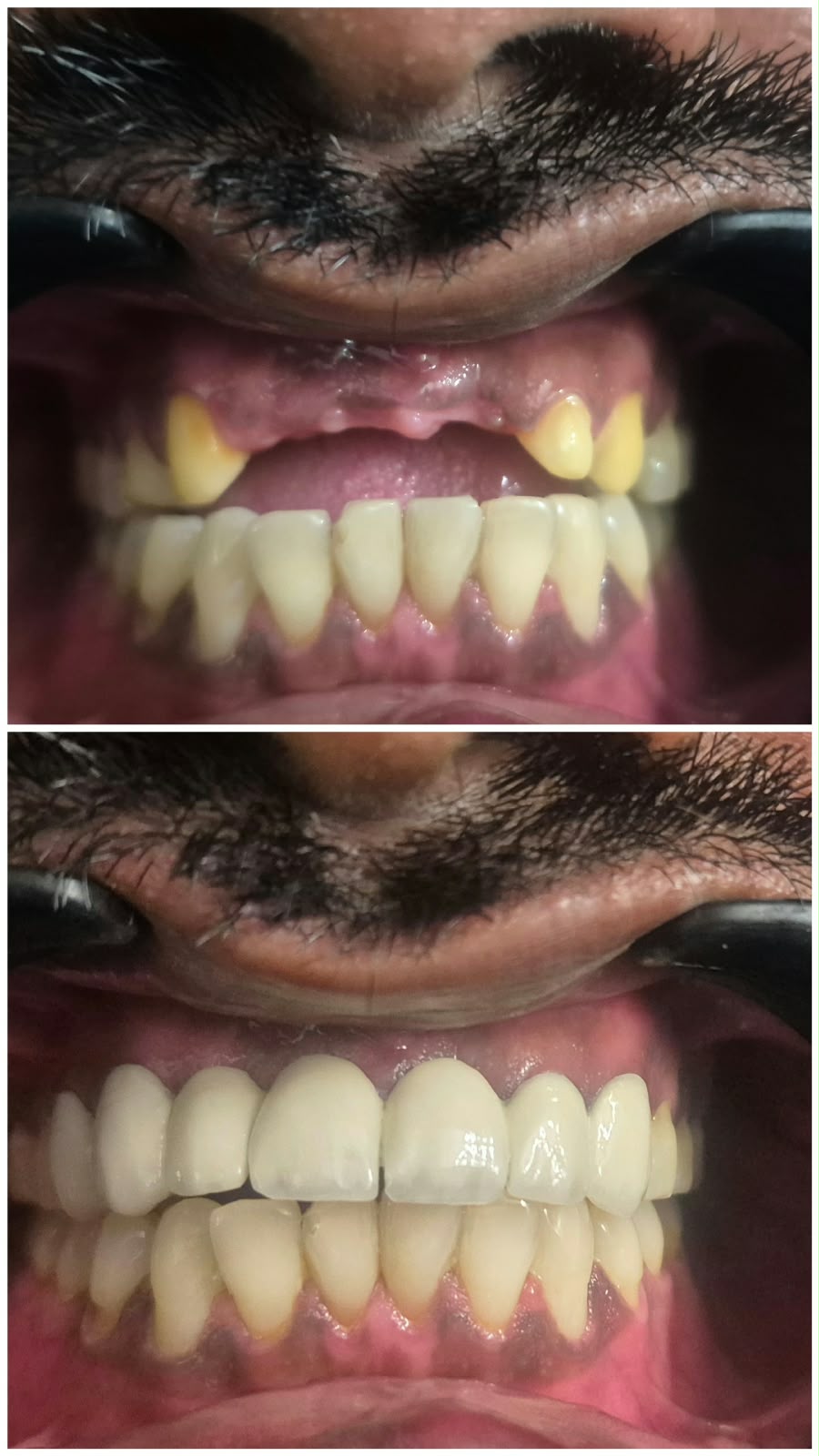 Crown treatment photo 1