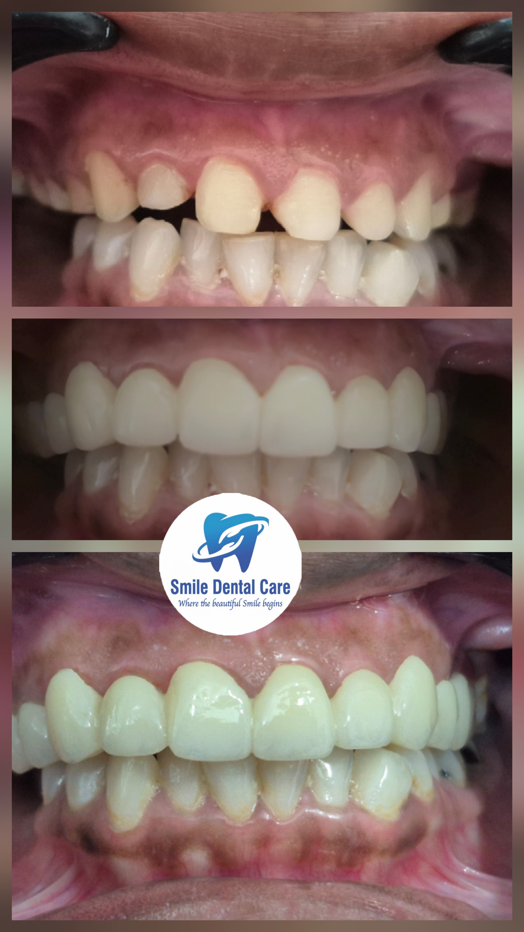 Crown treatment photo 2