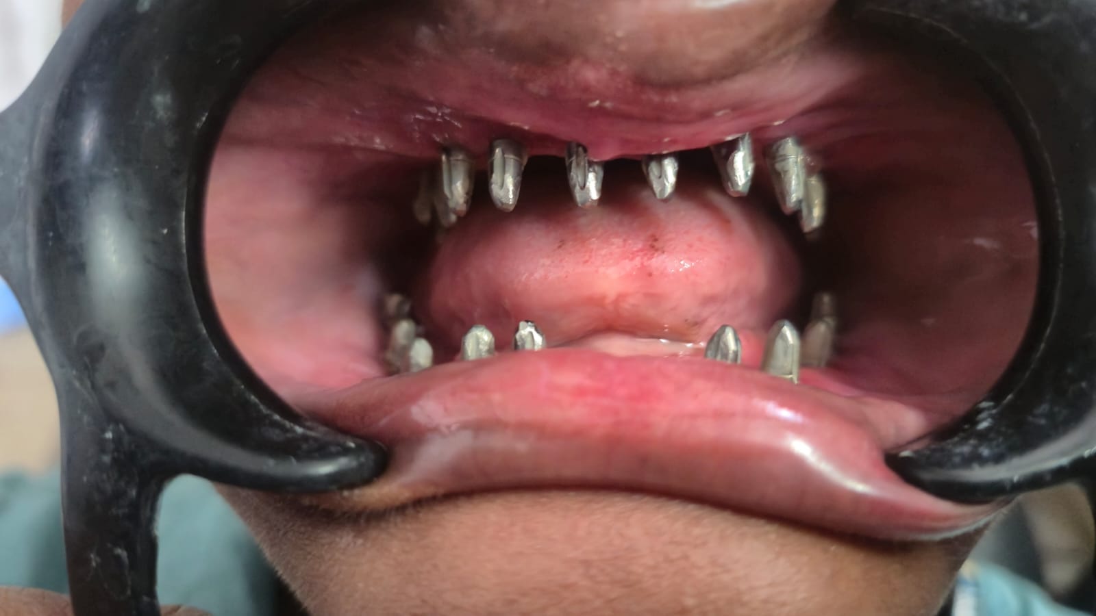 Full Mouth Implant photo 1