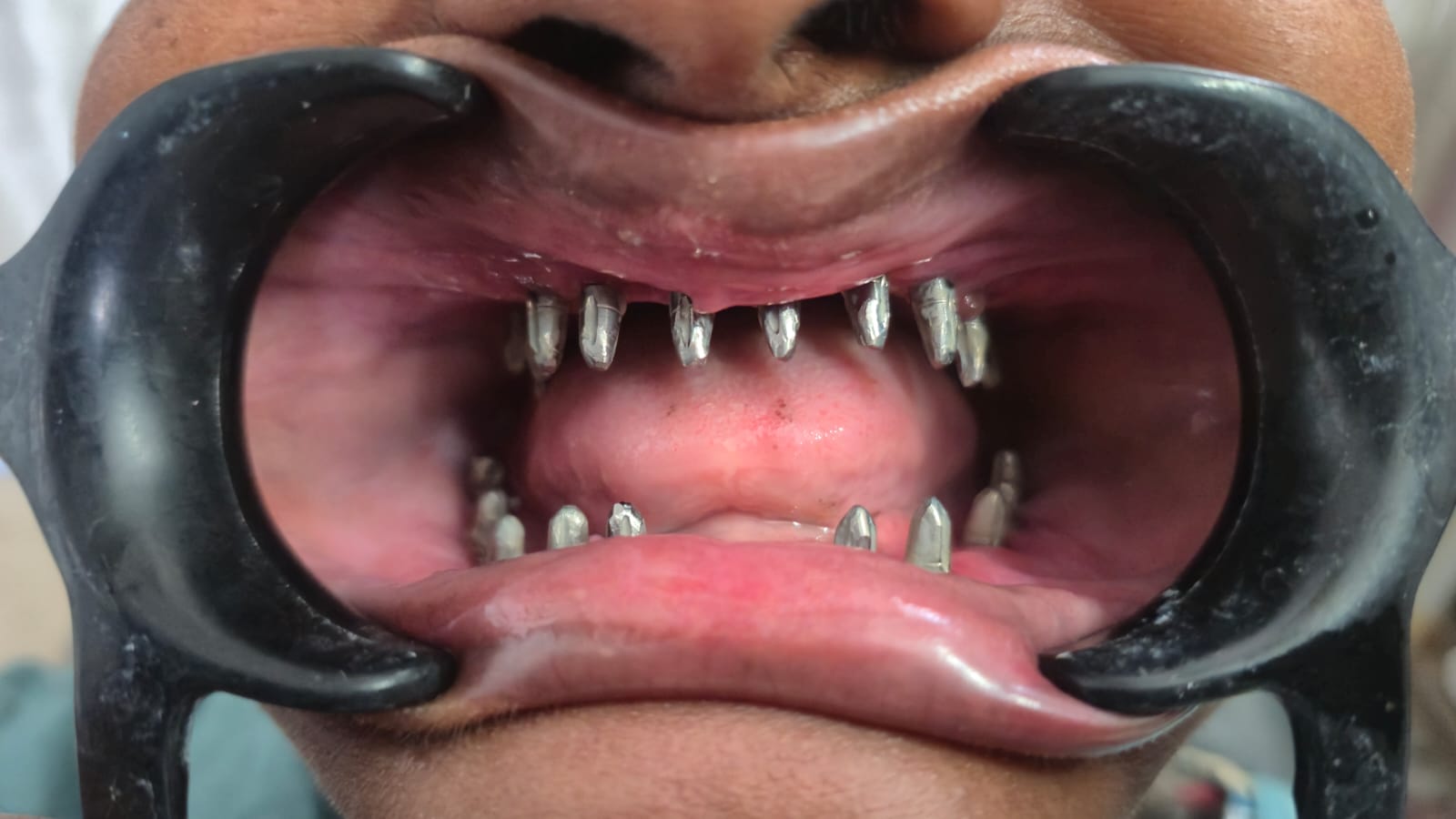 Full Mouth Implant photo 2