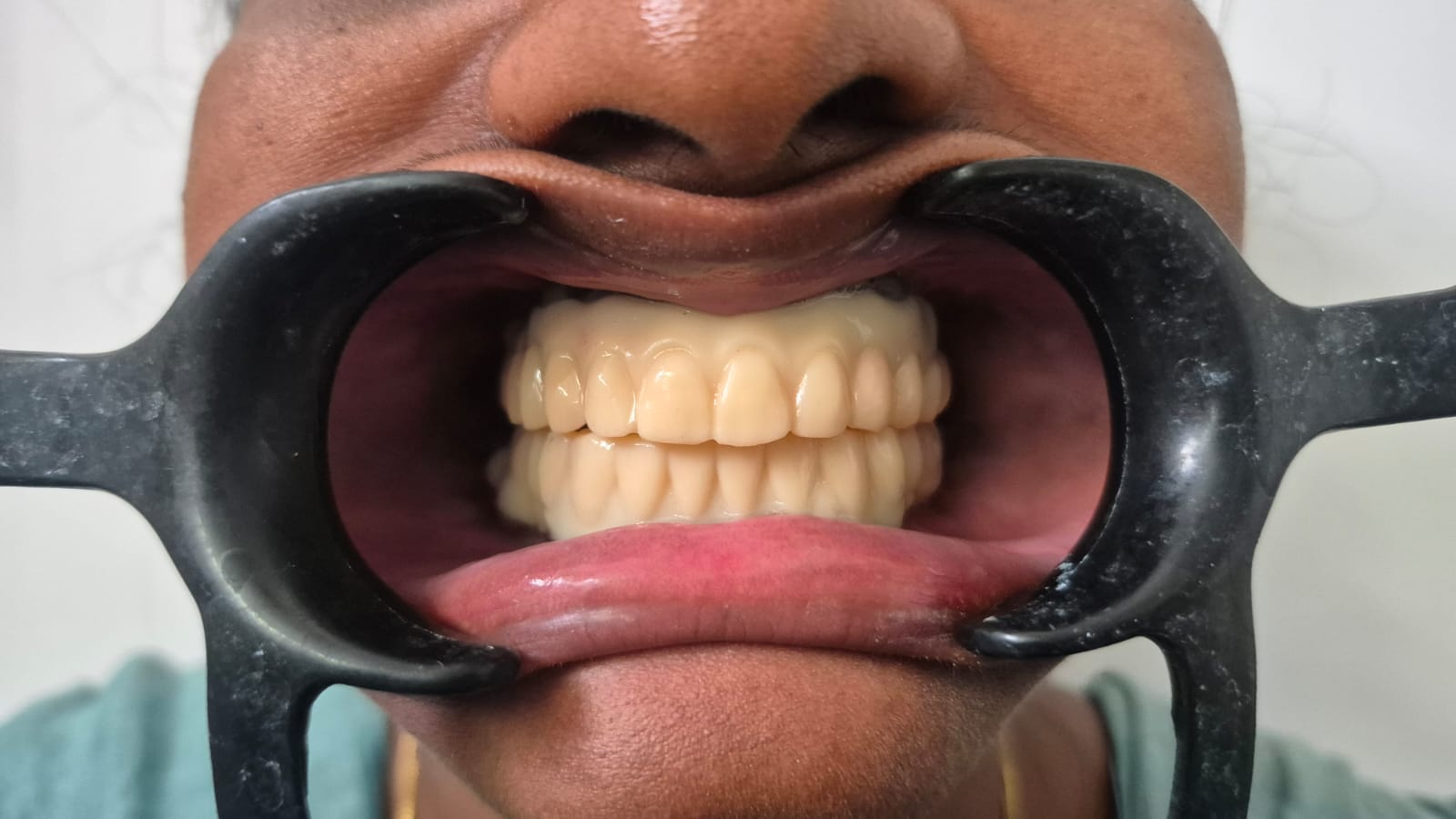 Full Mouth Implant photo 3