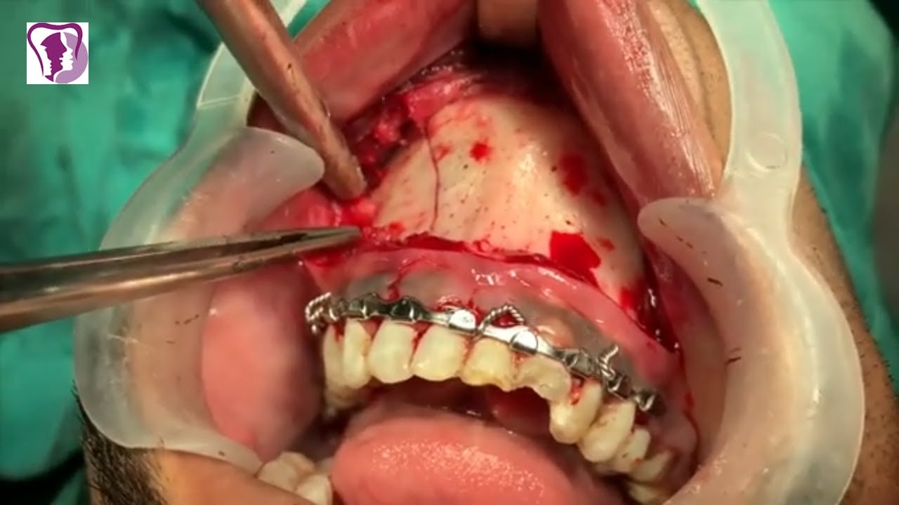 Jaw Bone Treatment photo 1