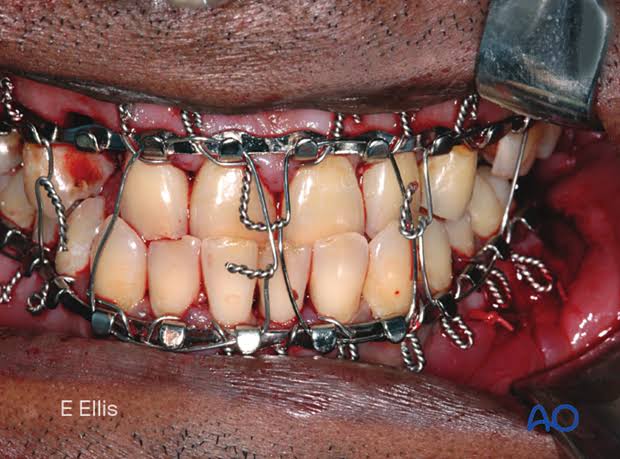 Jaw Bone Treatment photo 2