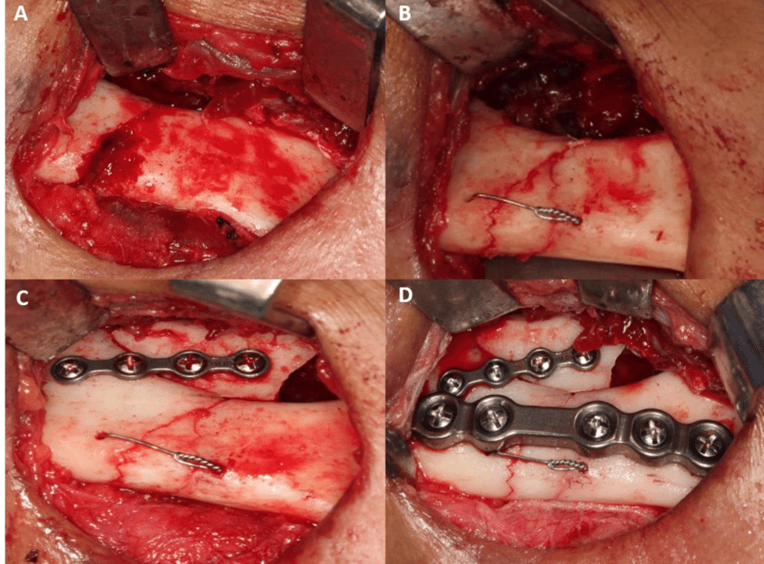 Jaw Bone Treatment photo 3