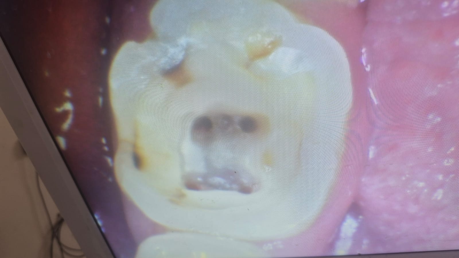 Root Canal Treatment photo 1