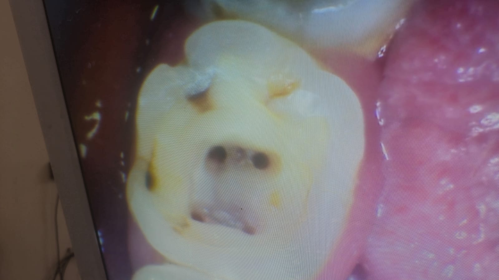 Root Canal Treatment photo 2