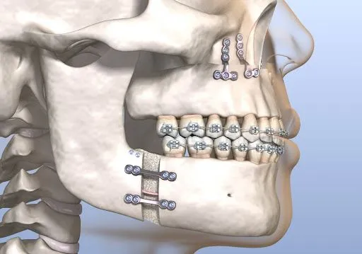 Jaw Bone Surgery