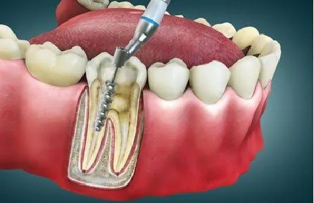 Root Canal Treatment